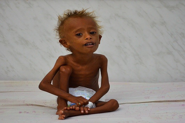 “اليونيسيف”: 1.4 مليون طفل يواجهون خطر الموت جوعا