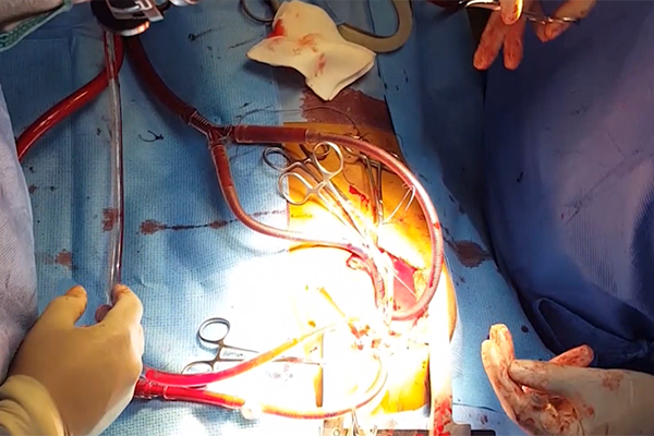 وهران: طاقم طبي شاب ينجح في إجراء عمليتين جراحيتين للقلب المفتوح