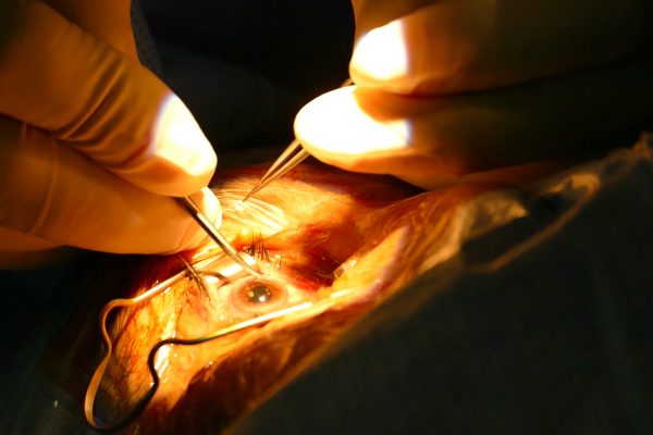 الأغواط: 250 عملية جراحيه مجانية لفائدة مرضى العيون