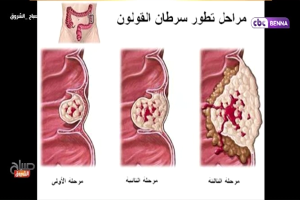 سرطان القولون “الشهر الأزرق” مع الدكتور حميدي