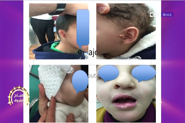 عمليات التجميل لمعالجة التشوهات عند الأطفال مع الدكتور عباد من بلاطو صباح الشروق